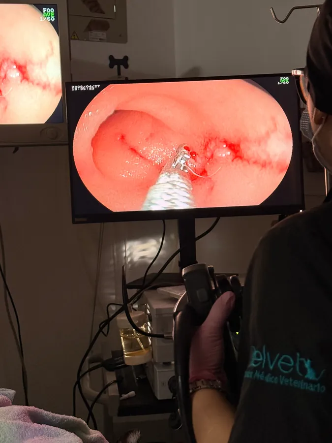 Endoscopia digestiva: la imagen del endoscopio en el monitor durante el procedimiento