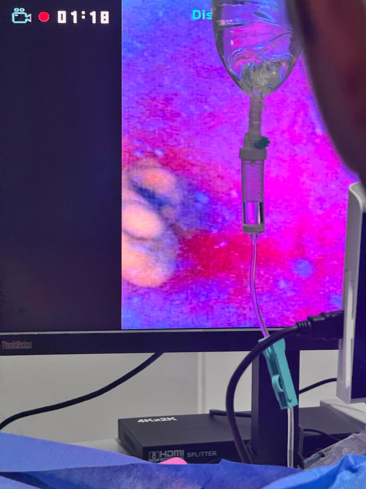 Imagen endoscópica en directo en el monitor del quirófano